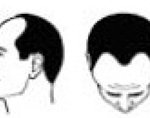 育毛お悩み・男性型脱毛症(AGA)必読、男性ホルモン過剰、毛深い、脱毛薄毛ハゲになりやすい？